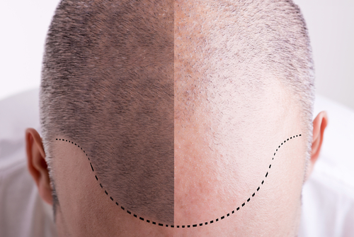What happens after a month of hair transplant and when do the results  appear? - BMS Clinics